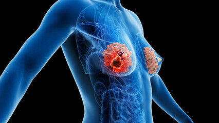 3d rendered medical illustration of breast cancer