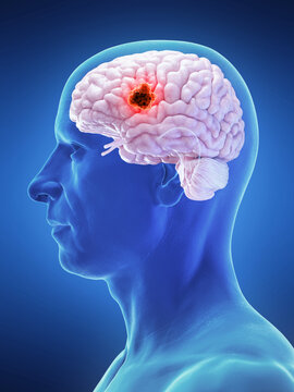 3d rendered medical illustration of brain cancer