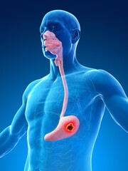 3d rendered medical illustration of stomach cancer