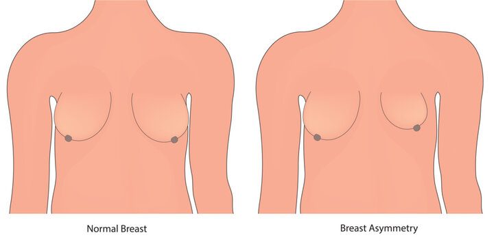breast asymmetry