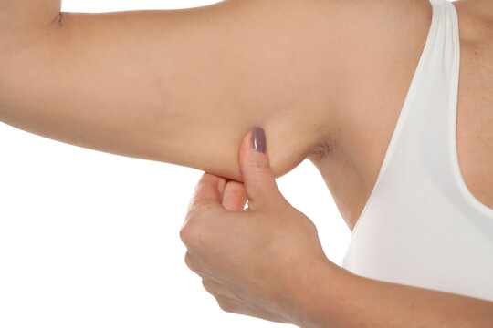 A middle aged woman grabbing skin on her upper arm with excess f