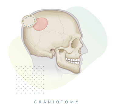 Craniotomy Surgery - Bone Flap Removal - Stock Illustration