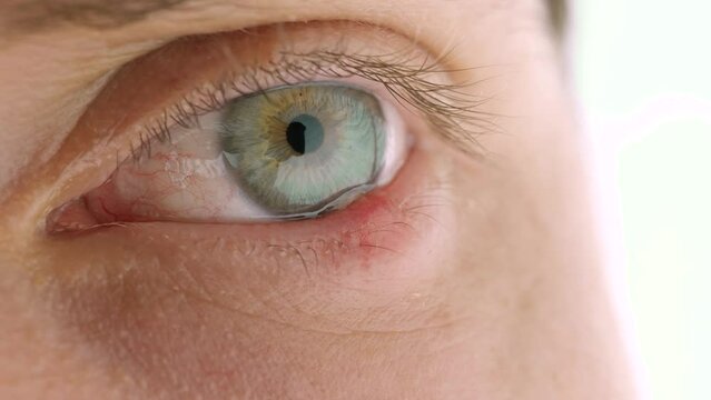Stye on eyelid (hordeolum) eye infection macro