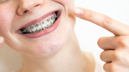 Close-up portrait of a young woman pointing at a smile with braces on her teeth.