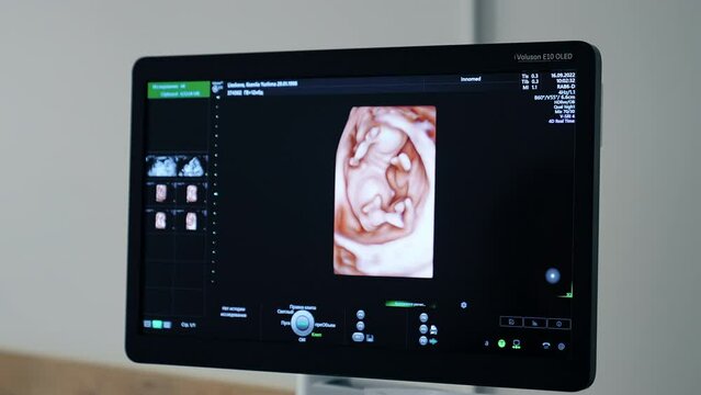 Black monitor with unborn baby image on. Ultrasound equipment for diagnostics of pregnancy.