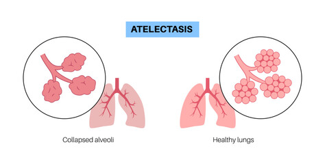 Atelectasis medical poster - 596509128