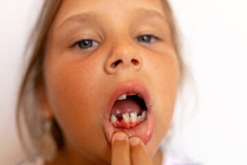 Fearless, brave little girl pull off lip, show toothless mouth and fresh wound bleeding after tooth...