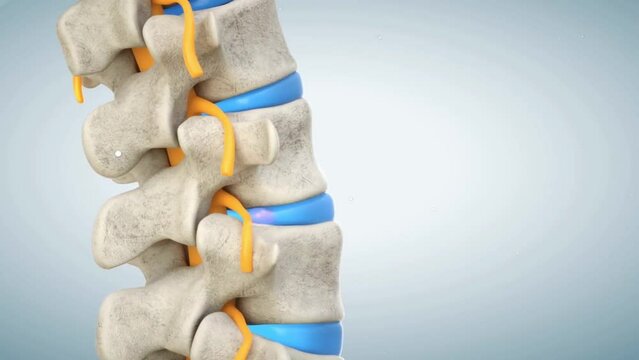 human lumbar spine demonstrating herniated disc, pressure nerve root causing back pain 3 D