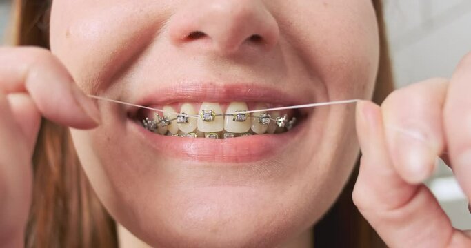 Woman with braces brushing her teeth with dental floss, close-up, front view.