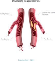 Cholesterol deposits (plaques) in the heart arteries and inflammation are usually the cause of coronary artery disease. Artery blockage vector illustrations.