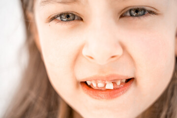 Charming smiling little girl kid with opened mouth shows staggering loose falling out first baby milk front tooth. Preschooler teeth changing. Healthy dental hygiene. Lost tooth. Dentist treatment