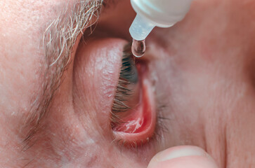 Instillation of drops into eye. A man drips drops. Ophthalmology