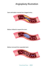 Cholesterol deposits (plaques) in the heart arteries and inflammation are usually the cause of coronary artery disease. Artery blockage vector illustrations.