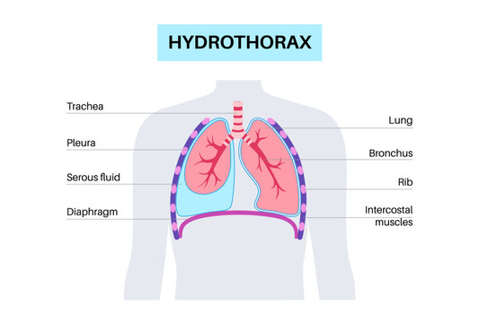Hydrothorax medical poster