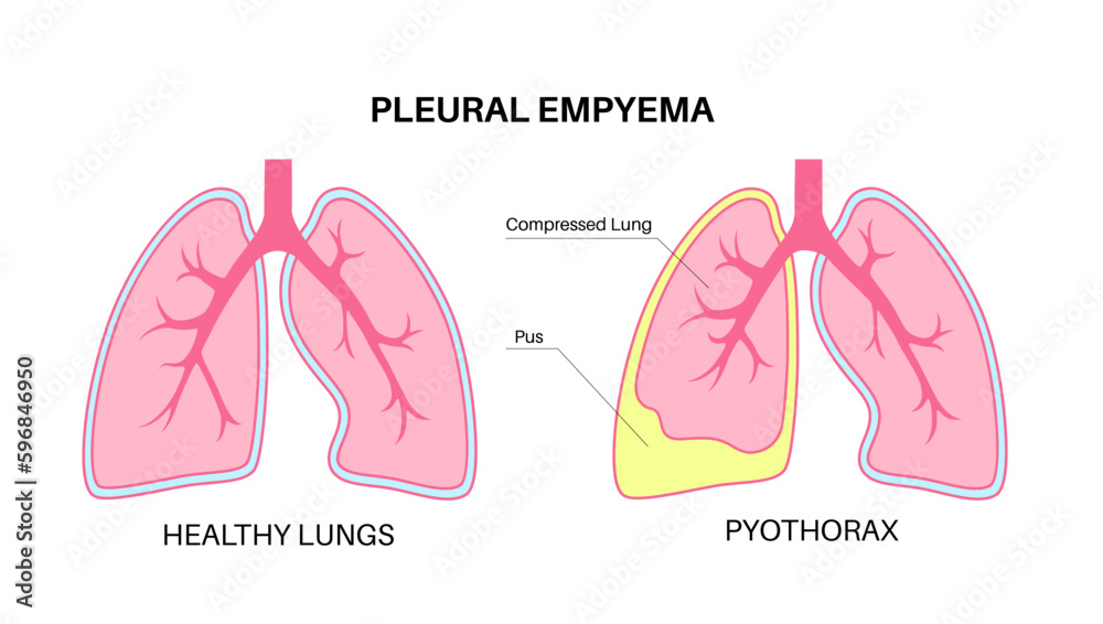 Sticker pyothorax pleural empyema