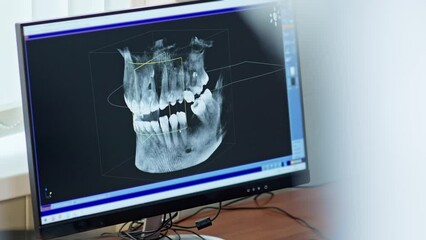 Dentist looking 3d model of x-ray of patient's jaw. 3d model of teeth on computer monitor. Diagnostics. Concept of dental care. MRI of jaw. Medical digital technology. - Powered by Adobe