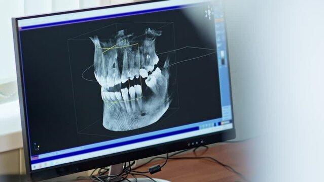 Dentist looking 3d model of x-ray of patient's jaw. 3d model of teeth on computer monitor. Diagnostics. Concept of dental care. MRI of jaw. Medical digital technology.