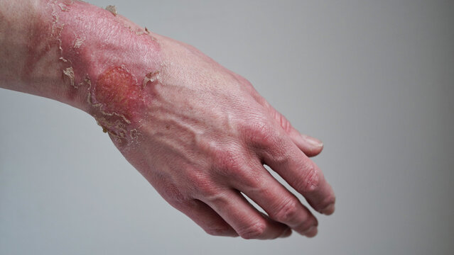 Close-up of a woman's hand with a burst blister from a boiled water burn, broken skin, 1st or 2nd degree burn. Painful wound. Thermal burn. Skin peels off after a burn, wound treatment. macro photo