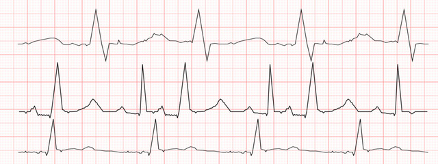 Set of black heartbeat diagrams on red graph paper. ECG electrocardiogram chart. Cardiac rhythm line. Cardio test signs. Vector graphic illustration