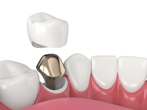 3d render of lower jaw with cast post and core tooth restoration