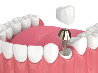 3d render of lower jaw with cast post and core tooth restoration