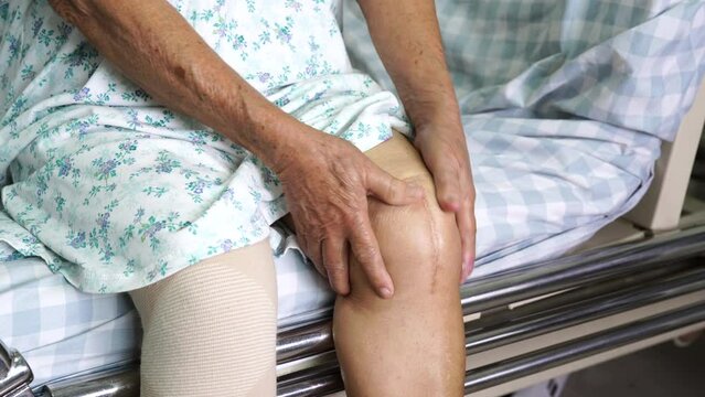 Asian senior or elderly old lady woman patient show her scars surgical total knee joint replacement Suture wound surgery arthroplasty on bed in nursing hospital ward, healthy strong medical concept.