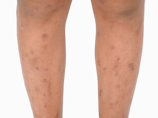 Asian boy has allergies with mosquitoes bite. Many mosquito bites hurt and scars on the legs. Closeup photo, blurred.