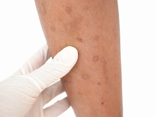 Asian boy has allergies with mosquitoes bite. Many mosquito bites hurt and scars on the leg. Closeup photo, blurred.