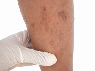 Boy's legs with many red spot and scar from insect bites. Closeup photo, blurred.