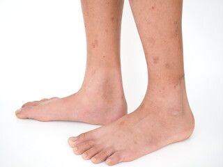 Boy's legs with many red spot and scar from insect bites. Closeup photo, blurred.