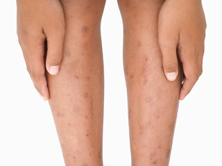 Boy's legs with many red spot and scar from insect bites. Closeup photo, blurred.