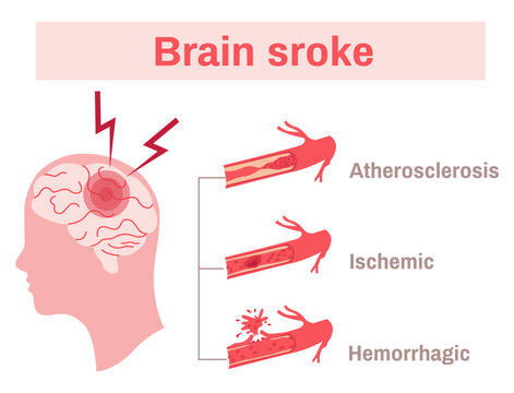 Stroke Flat Infographics