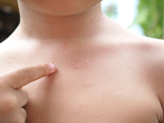 Asian kid's chest rash is caused by urticaria, food allergies, insect bites. health concept. Closeup photo, blurred.