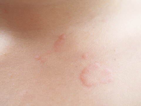 Asian kid's chest rash is caused by urticaria, food allergies, insect bites. health concept. Closeup photo, blurred.