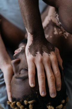 Top view of young african american man with vitiligo touching face while lying on bed.