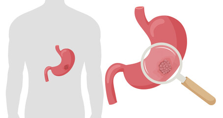  Stomach cancer. Malignant cancerous tumor enlarged under magnifying glass. Anatomical vector illustration isolated white background cartoon style