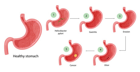 Stomach diseases. Diagram of diseases of helicobacter pylori, gastritis, erosion, ulcer and cancer. Educational anatomical vector illustration
