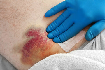 Hematoma on a men's leg close-up. Huge bruise on the leg of a man after endovascular repair due to...