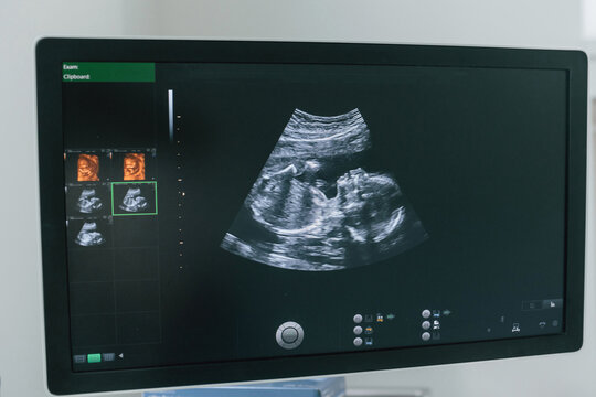 Pregnant baby infant ultrasound display. Conception of health care