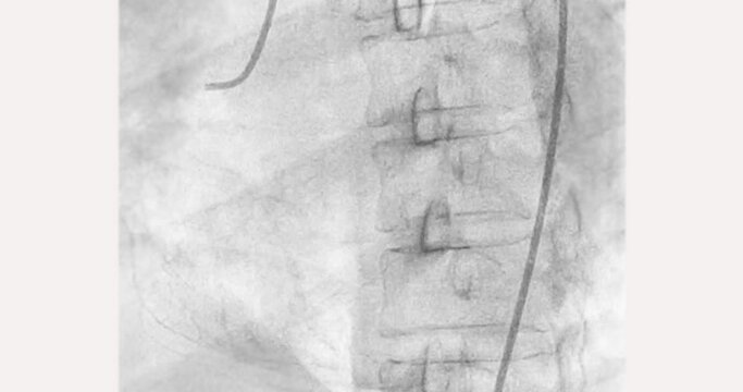 Cardiac catheterization showing coronary arteries  used to diagnose and treat some heart conditions.