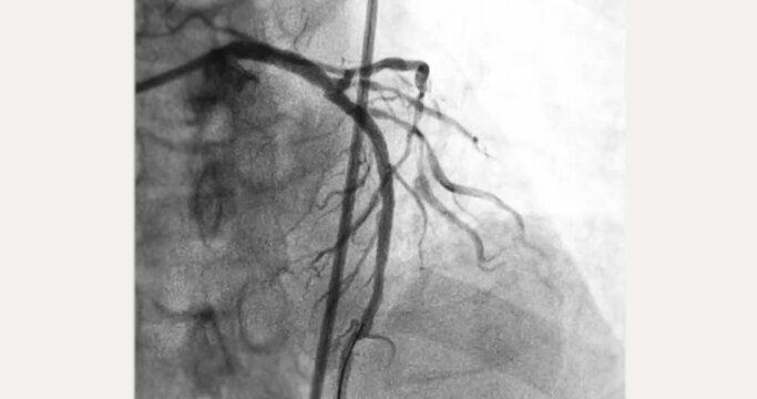 Cardiac catheterization showing coronary arteries  used to diagnose and treat some heart conditions.