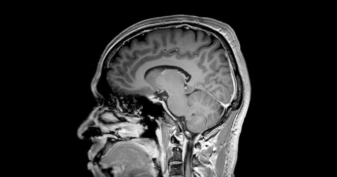 MRI of the brain sagittal T1 with gadolinium contrast media for diagnosis brain tumor and stroke diseases . magnetic resonance imaging of the brain.