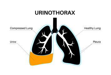 Urinothorax anatomical poster