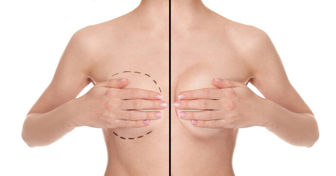 Breast augmentation with silicone implant. Photo of woman divided in halves before and after plastic surgery, collage on white background