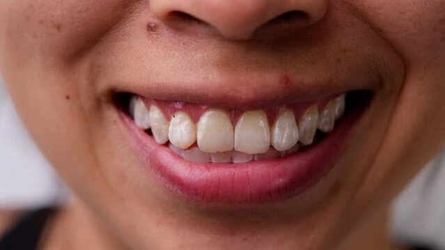 Close up front view of Asian woman smiling happily revealing her teeth with white spots and plaque.