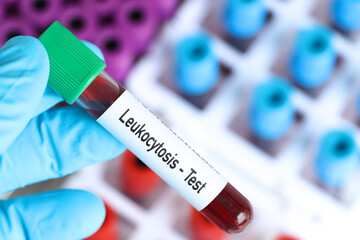 Fototapeta premium Leukocytosis test, blood sample to analyze in the laboratory