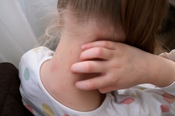 The child scratches atopic skin. Dermatitis, diathesis, allergy on the child's face.