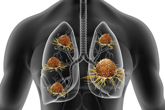 Human lung cancer growth. 3d illustration.