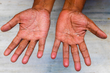 exfoliative keratolysis,focal palmar peeling skin disease.