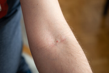 Small mark left by the needle on the elbow pit of a Caucasian male arm. Close up shot, unrecognizable person.